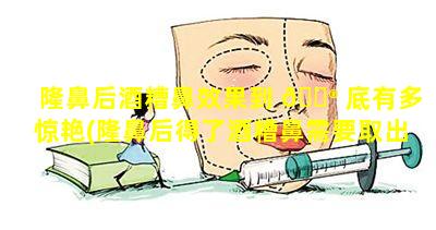 隆鼻后酒糟鼻效果到 💮 底有多惊艳(隆鼻后得了酒糟鼻需要取出假体吗)